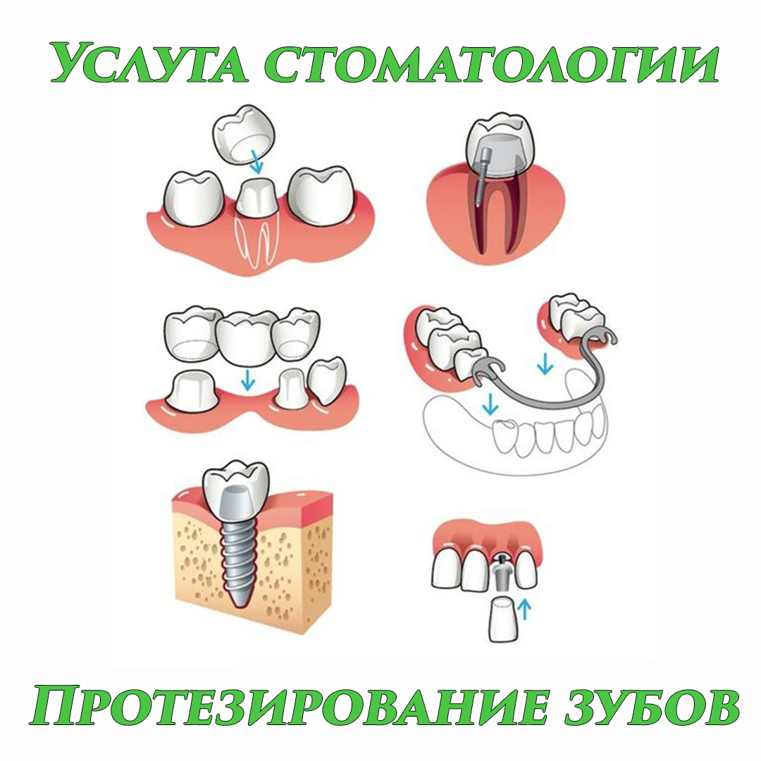 Схемы протезирования зубов